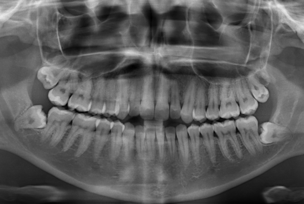 Panoramic X-ray image showing 4 wisdom teeth that need to be removed