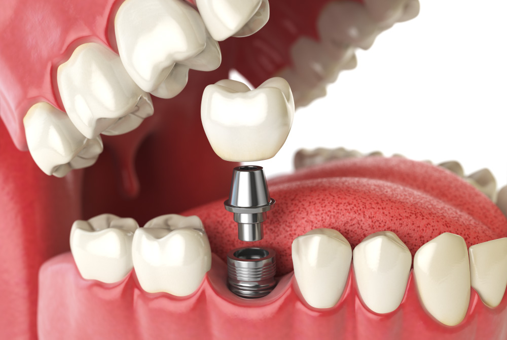 A dental implant topped with a dental crown as a permanent tooth replacement solution in St. George & Ivins, UT